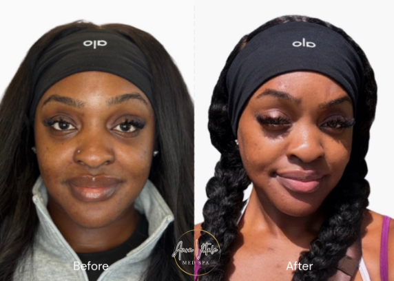 collagen stimulation therapy​ image1