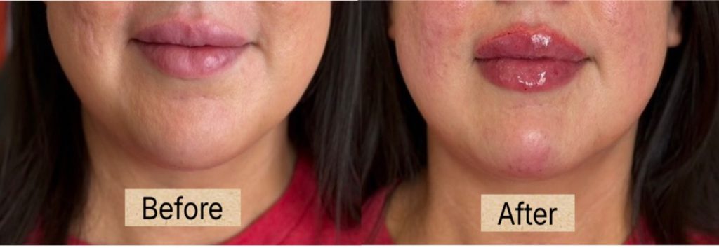 dermal filler picture1