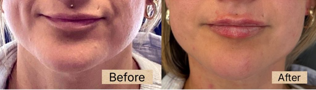 dermal filler picture2